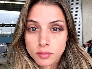 Angela Sousa desabafa na web e mostra hematomas no rosto