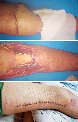 FONTE DE RENDA INTERROMPIDA POR GRAVES ACIDENTES